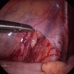 Varicocele_clip_image002_0006.jpg