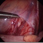 Varicocele_clip_image002_0006_thumb.jpg