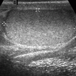 Ultrasound measurement of testicular size