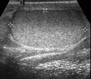 Ultrasound measurement of testicular size