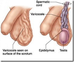 varicocele condition