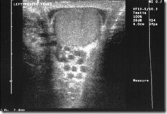 varicocele scan